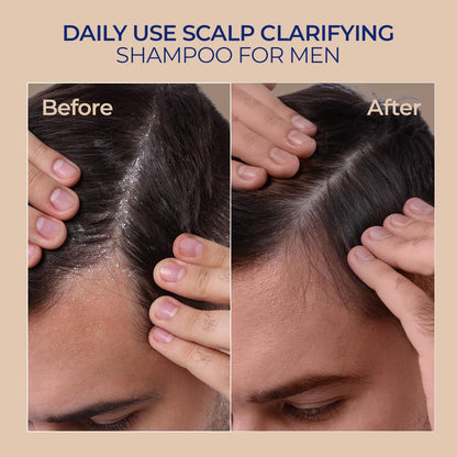 Before and after comparison of scalp with daily use scalp clarifying shampoo for men.