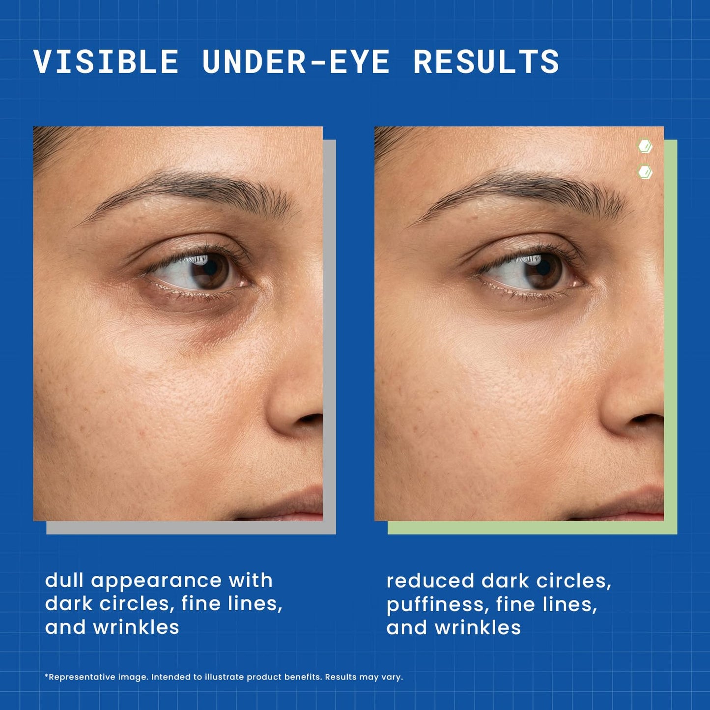 DERMDOC Niaglow 4% Niacinamide Under Eye Gel, 15gm | Reduces Dark Circles & Puffiness | Cools & Soothes | Lightweight | Fast Absorbing | Brightening Eye Care Gel for Tired Eyes & Fine Lines