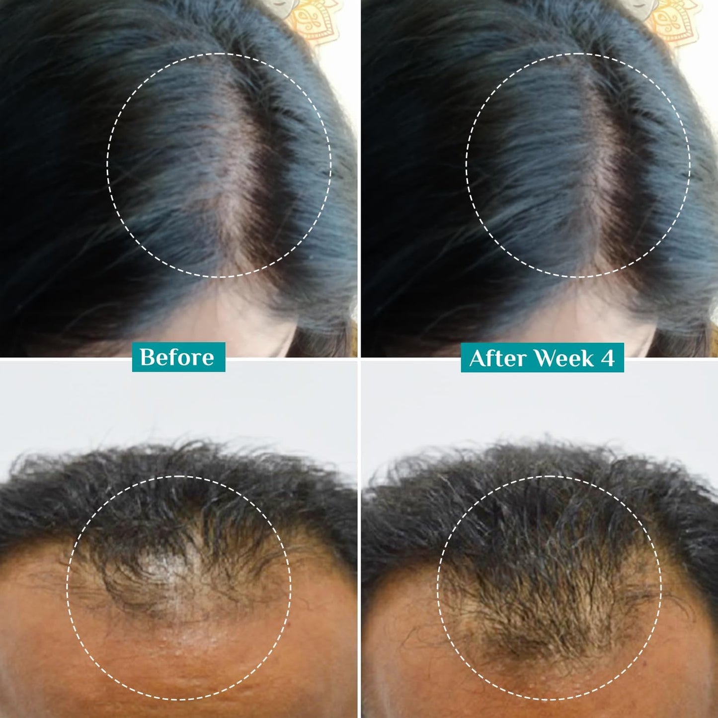 Pilgrim Redensyl 3% + Anagain 4% + 5% Capilia Stem Advanced Hair Growth Serum (30ml) for Scalp with Korean Black Rice & Rosemary | Control Hair Fall, Stimulate Hair Regrowth, Increase Hair Density