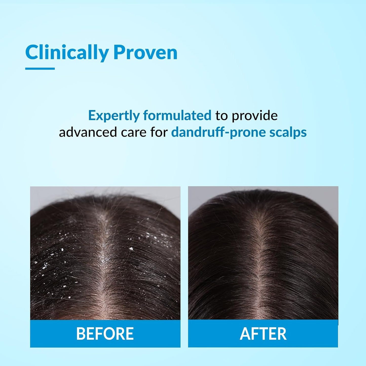 Fixderma Bioteez Advance Anti Dandruff Shampoo for Itchy & Psoriasis Scalp with Salicylic Acid| For Men & Women | Psoriasis Shampoo for Scalp - 75ml