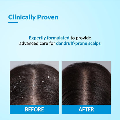 Fixderma Bioteez Advance Anti Dandruff Shampoo for Itchy & Psoriasis Scalp with Salicylic Acid| For Men & Women | Psoriasis Shampoo for Scalp - 75ml