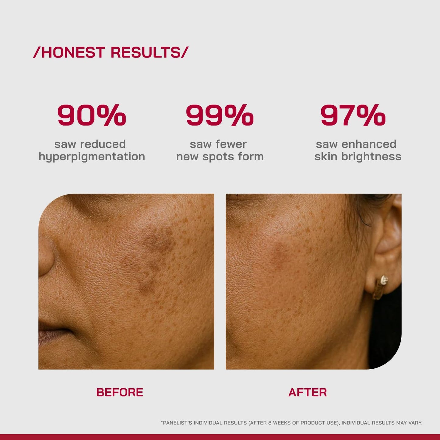 Proven Honest Derma /PHD/ 2% Alpha Arbutin Depigmentation Serum | Alpha Arbutin for Pigmentation & Dark Spot | Pigmentation serum for Women & Men | Tyrobright™, Niacinamide | Tan removal | Fragrance-Free | 30ml