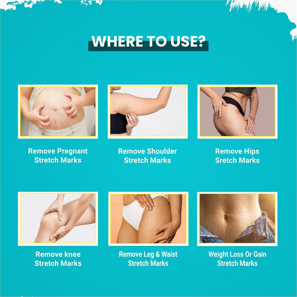 Instructions on where to use a product for stretch marks on various parts of the body against a blue background.