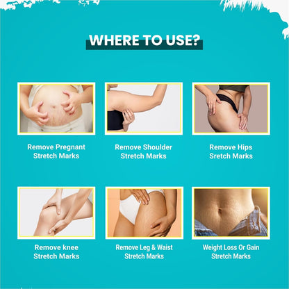 Instructions on where to use a product for stretch marks on various parts of the body against a blue background.