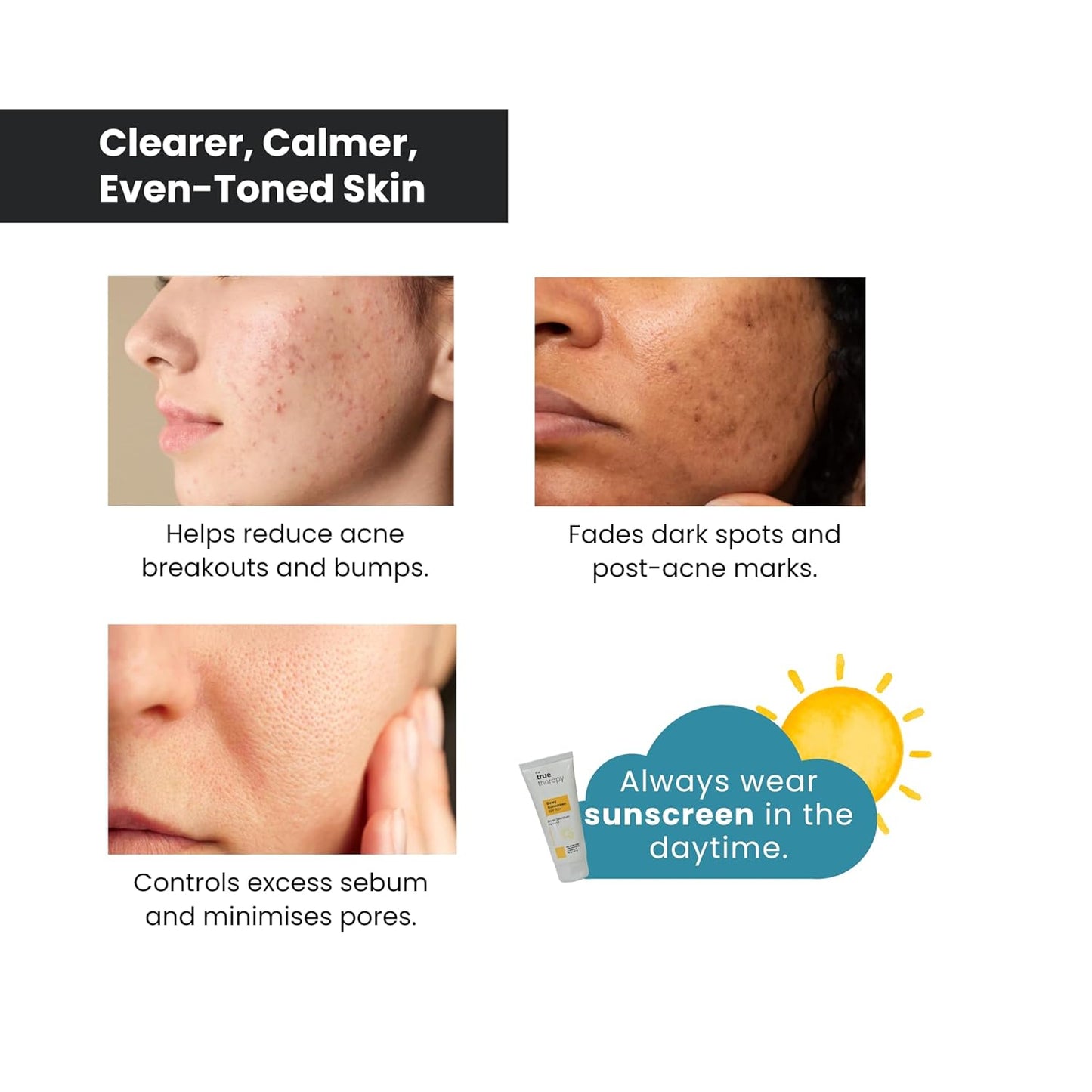 The True Therapy 10% Azelaic Acid Face Serum with Witch Hazel Extract for Anti-inflammatory, Cystic Acne, Rosacea, Hyperpigmentation, Reduce Redness, Excess Oil & Breakout – 30 ml