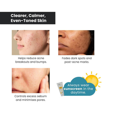 The True Therapy 10% Azelaic Acid Face Serum with Witch Hazel Extract for Anti-inflammatory, Cystic Acne, Rosacea, Hyperpigmentation, Reduce Redness, Excess Oil & Breakout – 30 ml