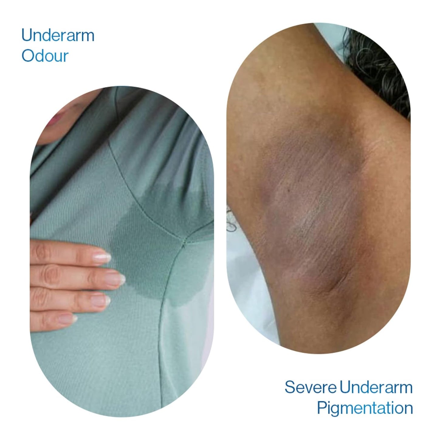 Be Bodywise Advanced Pigmentation Kit | With 6% AHA BHA Flora Underarm Roll-On (50ml) & Pigmentation Repair Cream (100g) | Reduces Body Odor, Fades Pigmentation & Corrects Uneven Skin Tone