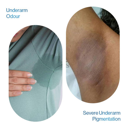 Be Bodywise Advanced Pigmentation Kit | With 6% AHA BHA Flora Underarm Roll-On (50ml) & Pigmentation Repair Cream (100g) | Reduces Body Odor, Fades Pigmentation & Corrects Uneven Skin Tone