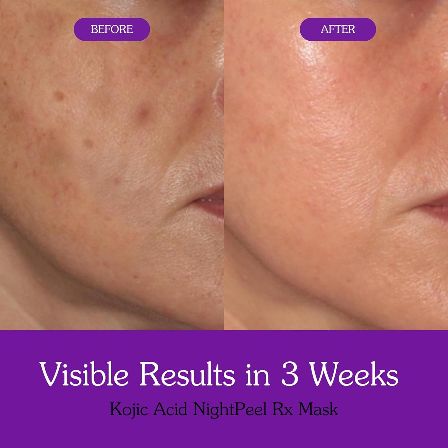 BAKE 1% Kojic Acid Night Peel Off Mask with Niacinamide & Turmeric | Reduces Pigmentation, Dark Spots & Tan | Overnight Peel Technology | Skin Brightening, Instant Glow - 100g