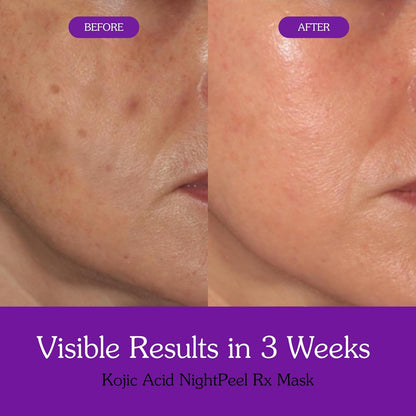 BAKE 1% Kojic Acid Night Peel Off Mask with Niacinamide & Turmeric | Reduces Pigmentation, Dark Spots & Tan | Overnight Peel Technology | Skin Brightening, Instant Glow - 100g