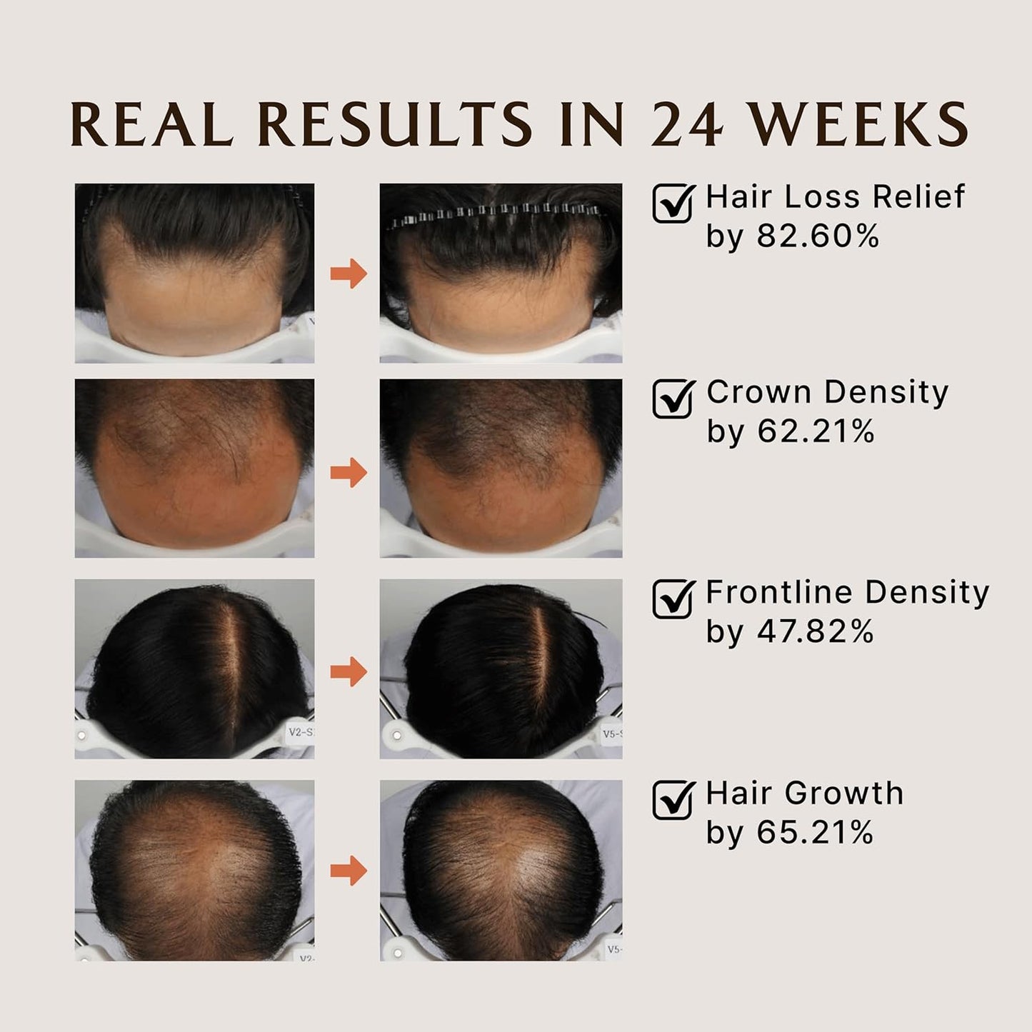 LADOR Dermatical Hair- Loss Shampoo (Normal to Dry Hair) (530ml) Anti Hair Loss & Hair Growth Korean Shampoo, Deep Cleanse, Nourish, Soothes Damaged Scalp