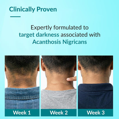 Fixderma Nigrifix Advance Cream for Acanthosis Nigricans with Melatonin, Retinol & Lactic Acid | For Dark Body Parts like Neck, Ankles, Knuckles, Armpits, Thighs & Elbows | Dermatologist Tested - 50g