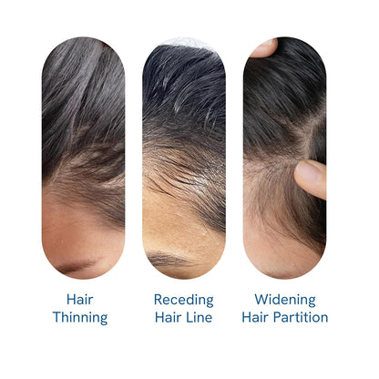 Be Bodywise Rosemary Hair Growth Serum (Roll On) | 3% Redensyl & 2% Anagain | Hair fall control serum for Women & Men | Promotes Hair Growth & Stimulates Hair Follicles | For All Hair Types | 25ml