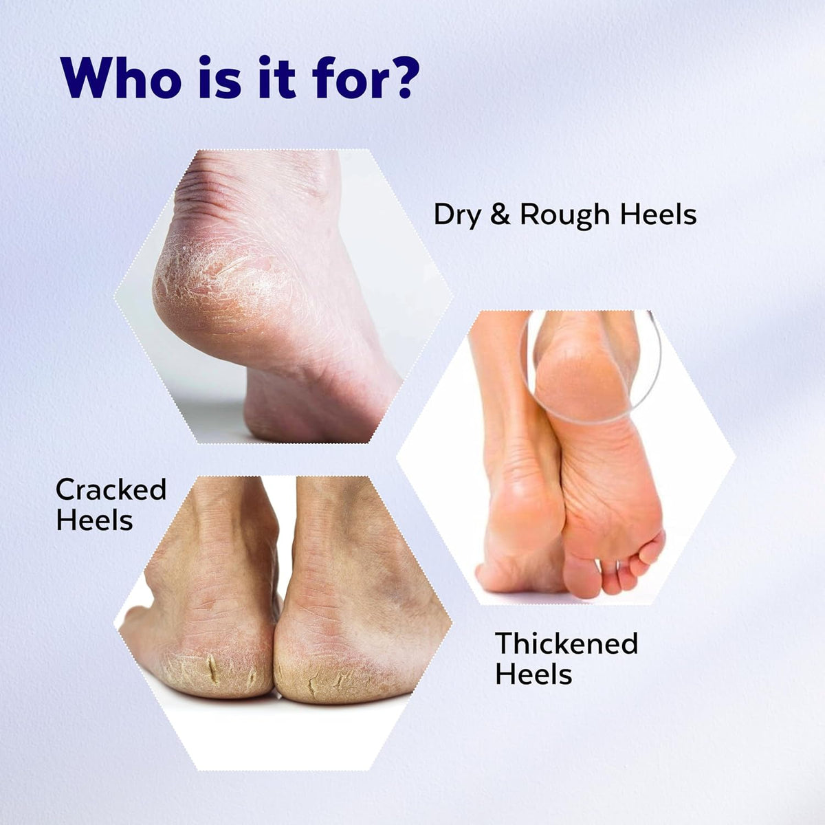 TrueWise 20% Urea Crack Heel Repair Foot Cream Roll On 50ml Foot Cream For Dry And Cracked Feet With 2% Lactic Acid, Olive Oil & Vitamin E | Help Heel Repair and Moisturise Cracked Heels