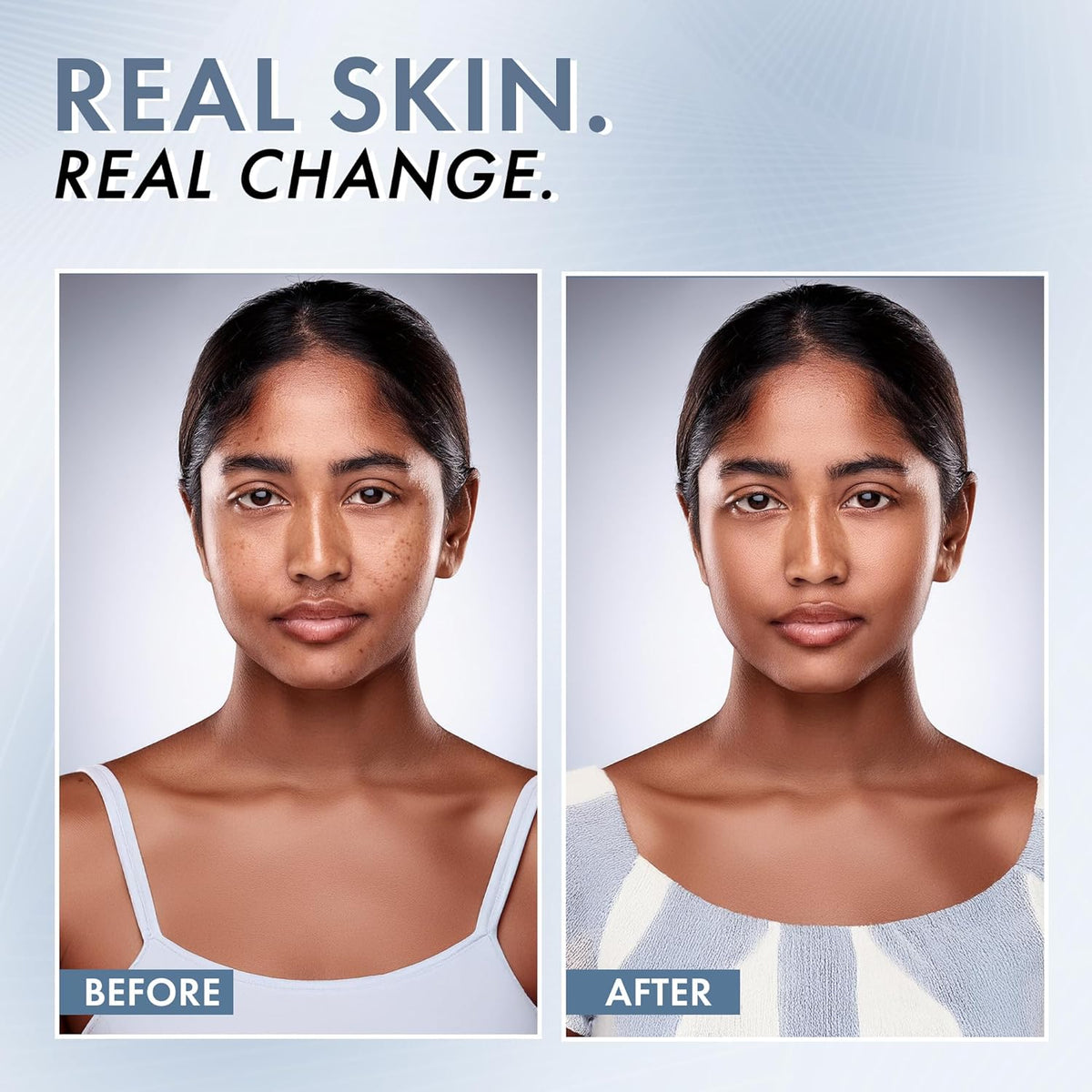 Before and after comparison of a woman's face with text 'Real Skin. Real Change.'