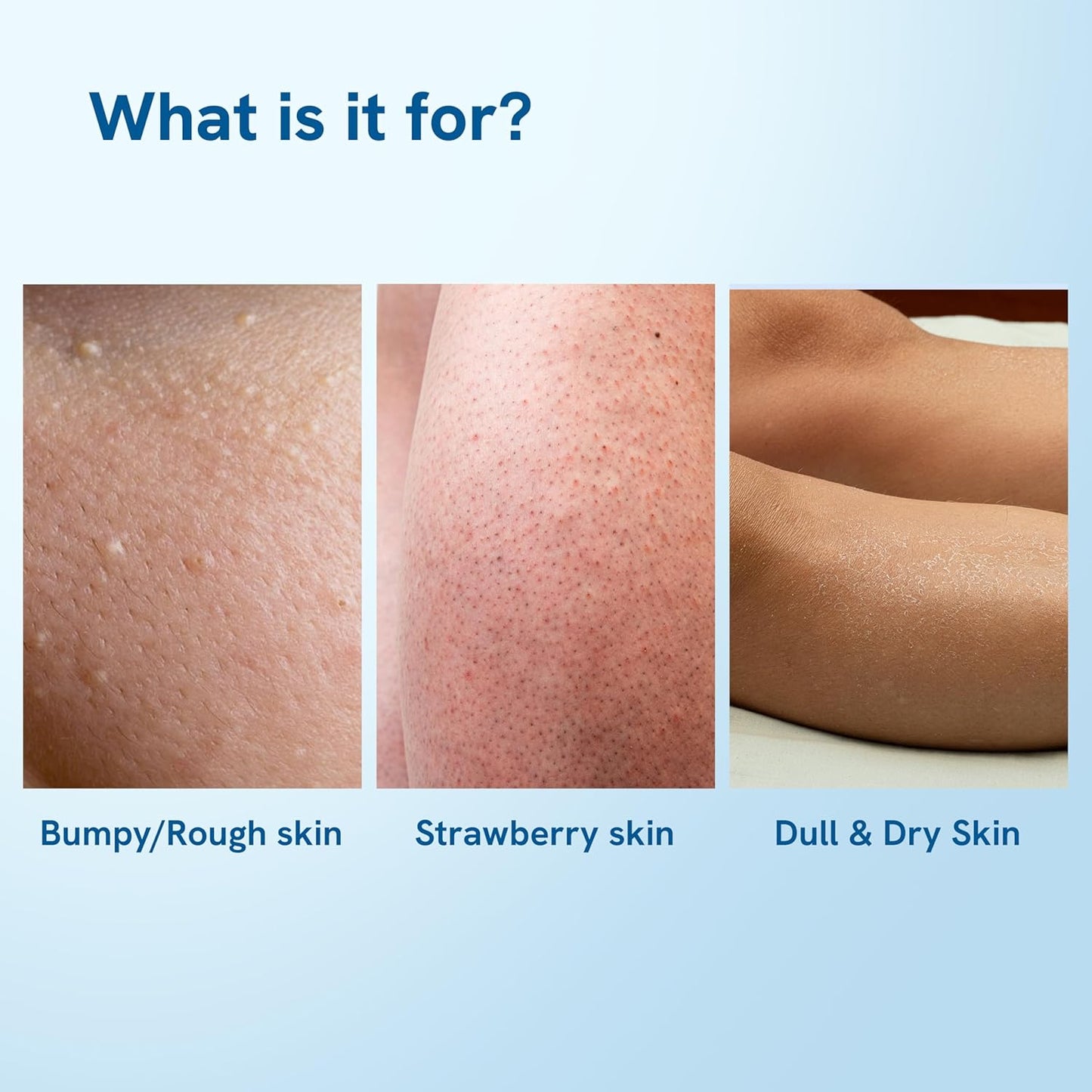 Be Bodywise 4% AHA BHA Shea Body Butter | 200g | With 48 hours of Intense Moisturization | For smooth and radiant skin