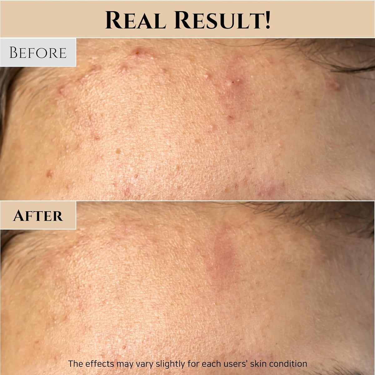 Before and after comparison of skin texture with 'Real Result!' text at the top.