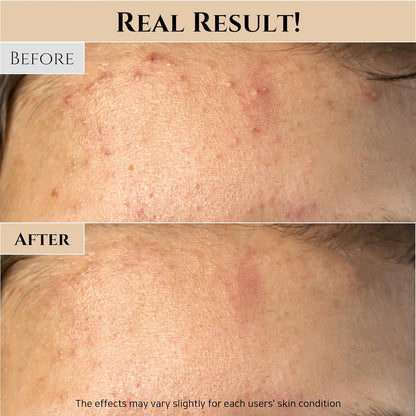 Before and after comparison of skin texture with 'Real Result!' text at the top.