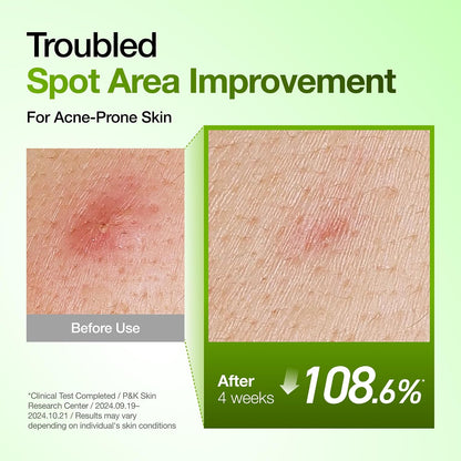 Anua Azelaic Acid 10 Hyaluron Redness Soothing Serum with Cica Soothes & Calms Acne-Prone Skin
