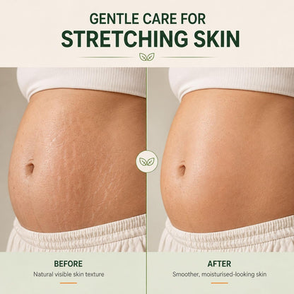 Pregnacream Stretch Mark Cream for Pregnancy & Post Pregnancy, 100g