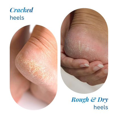 Be Bodywise 20% Urea Foot Cream Roll On 50ml | For Dry & Cracked Heels | With 2% Lactic Acid, Olive Oil & Vitamin E | Helps Repair and Moisturise Cracked Heels