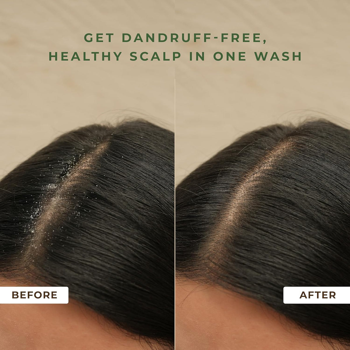 Before and after comparison of scalp with dandruff on a beige background