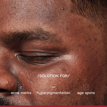 Proven Honest Derma /PHD/ 2% Alpha Arbutin Depigmentation Serum | Alpha Arbutin for Pigmentation & Dark Spot | Pigmentation serum for Women & Men | Tyrobright™, Niacinamide | Tan removal | Fragrance-Free | 30ml